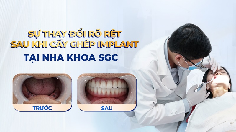 Dịch vụ trồng răng nha khoa SGC